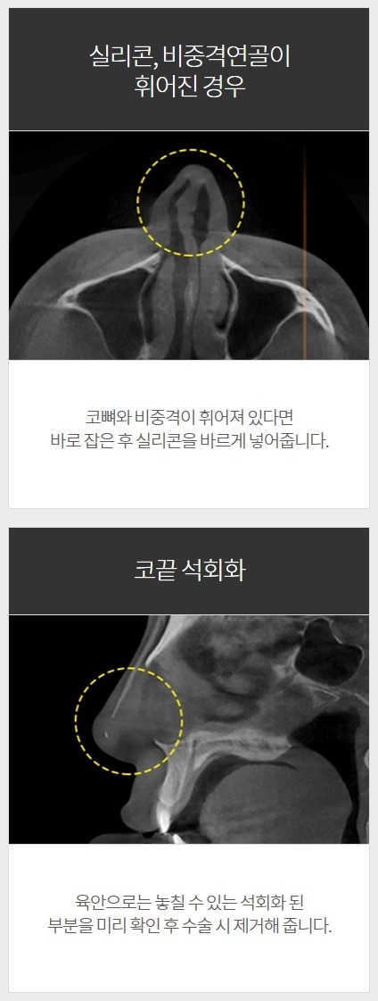 코구형구축 아이니크만의 솔루션이 정답! 관련 이미지 5