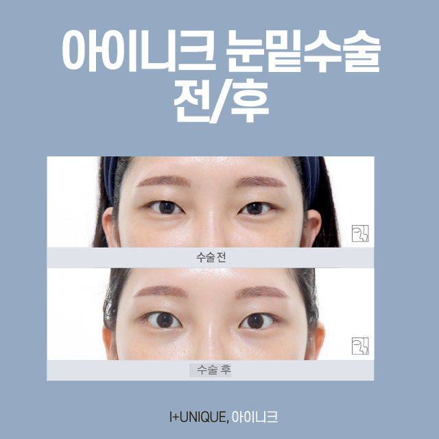 눈밑지방재배치 실패했다면? 이것이 답이다 관련 이미지 5