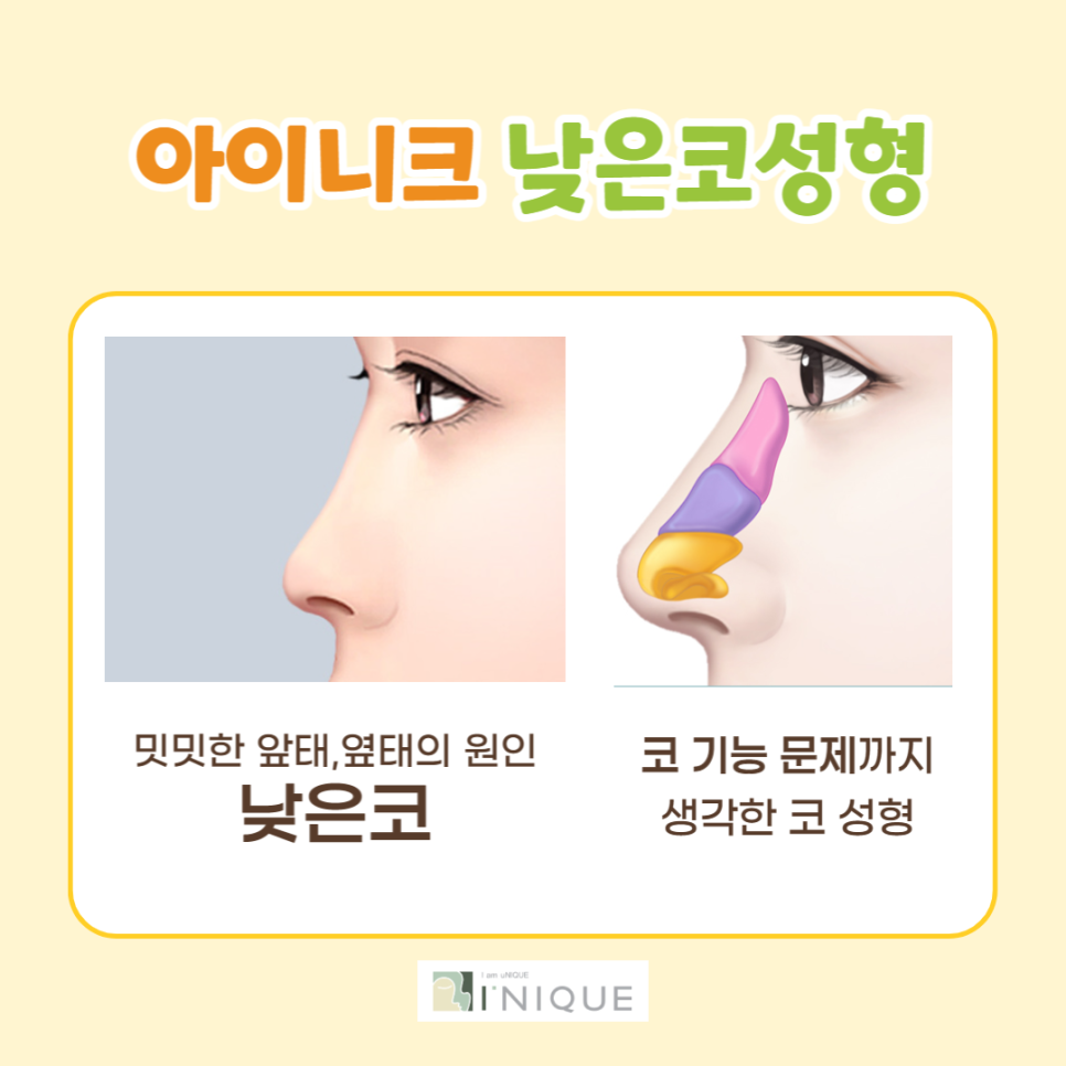 낮은코성형, 얼굴 전체를 고려해야 합니다. 관련 이미지 3