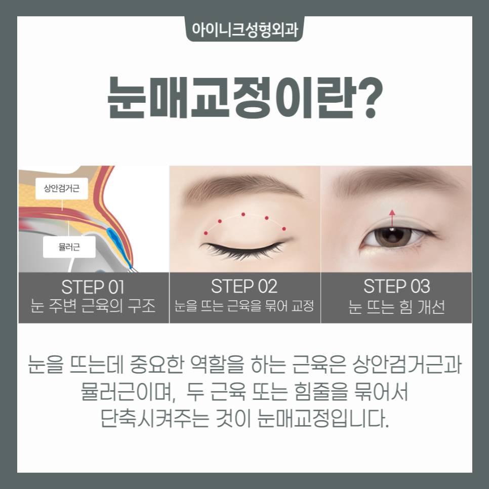 안검하수수술잘하는곳? 여기예요! 관련 이미지 4