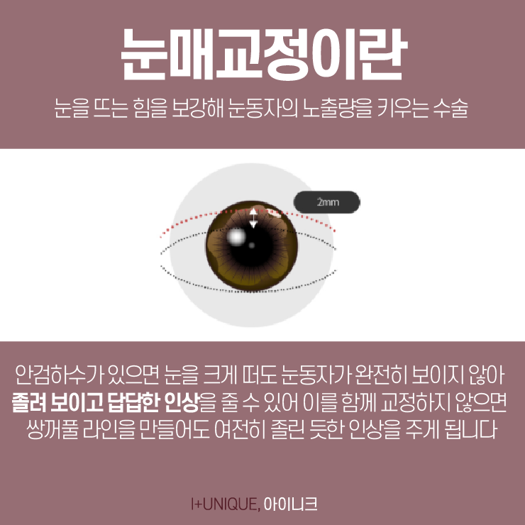 남자쌍꺼풀수술에 대해 알고싶다면, 아이니크성형외과를 주목하자 관련 이미지 3
