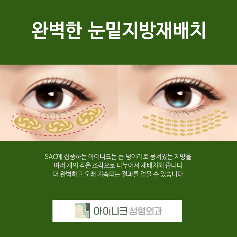 압구정역 눈밑 지방 재배치 후기 성공하는 방법 관련 이미지 4