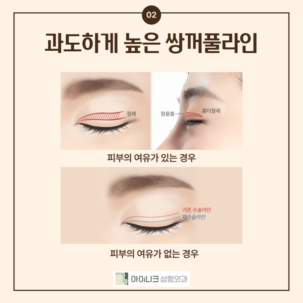If You’re Looking for a Place That Specializes in Revision Eyelid Surgery, Take Note! image 3