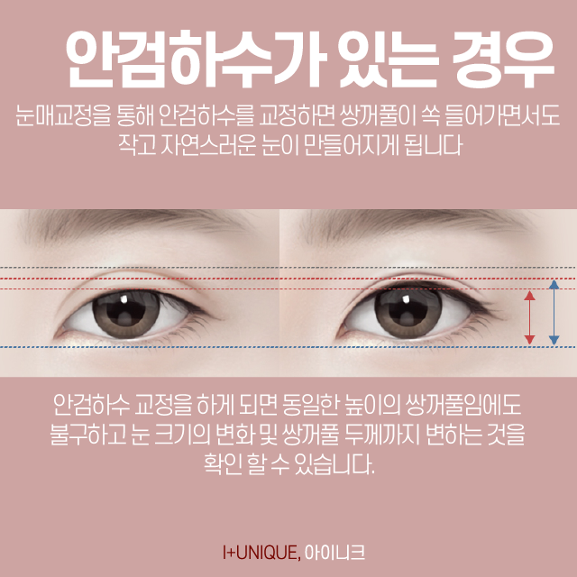 강남쌍꺼풀재수술 알아보고 있다면, 합리적인 선택을! 관련 이미지 4