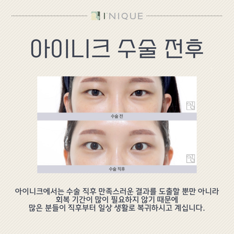 눈밑 주름 개선 방법 찾는다면 관련 이미지 6