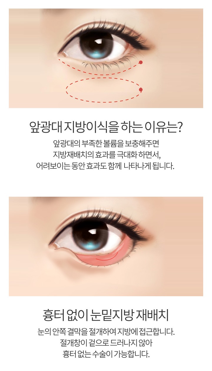 다크서클수술비용이 궁금하다면? 관련 이미지 4