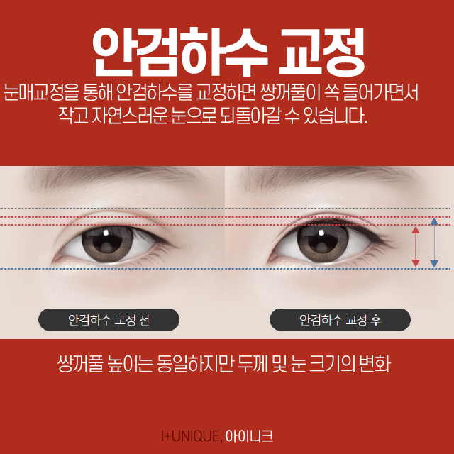 눈 재수술을 알아보고 있다면 압구정동성형외과 아이니크에서! 관련 이미지 4