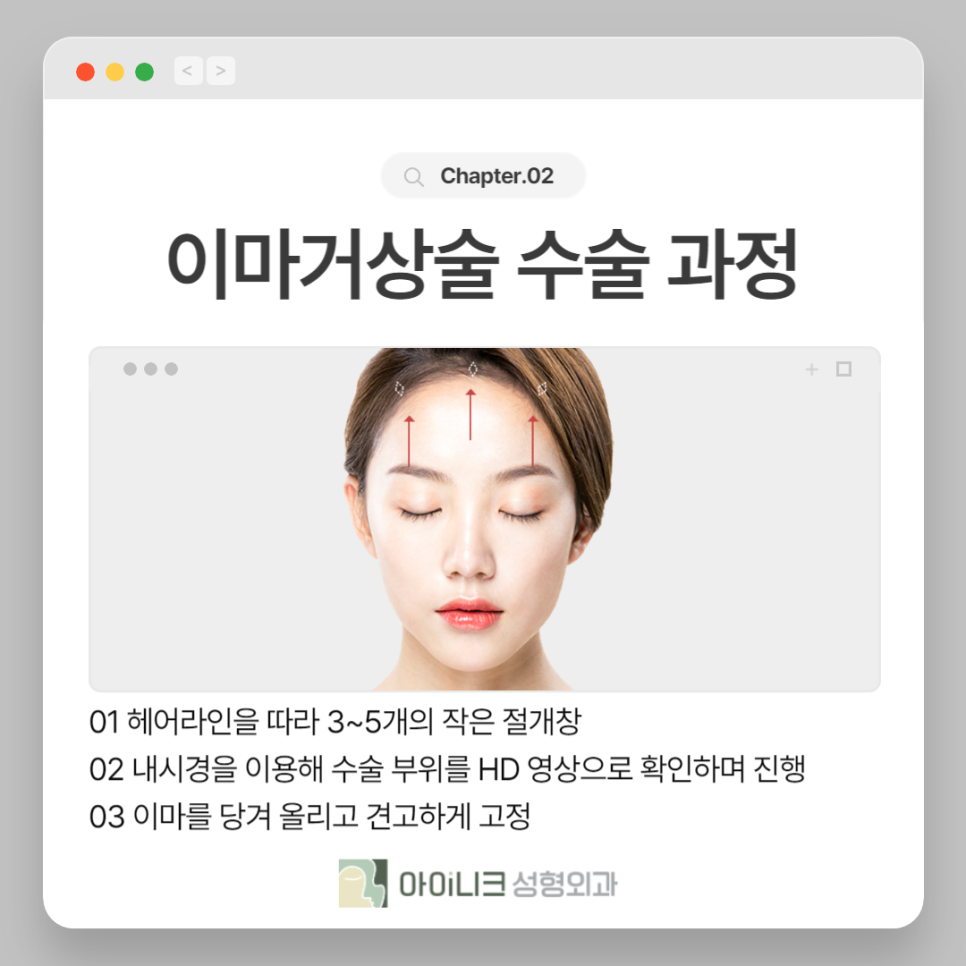 20대 이마거상술로 처진 피부를 개선 관련 이미지 4
