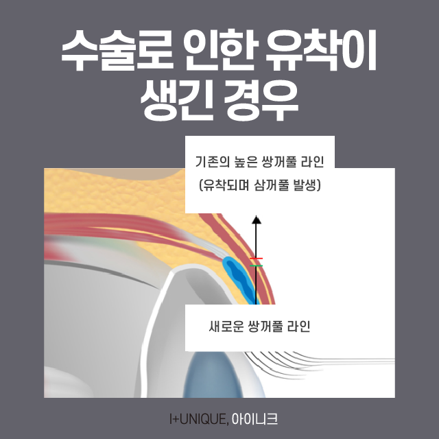 쌍꺼풀 여러겹 해결하고 싶다면? 관련 이미지 5