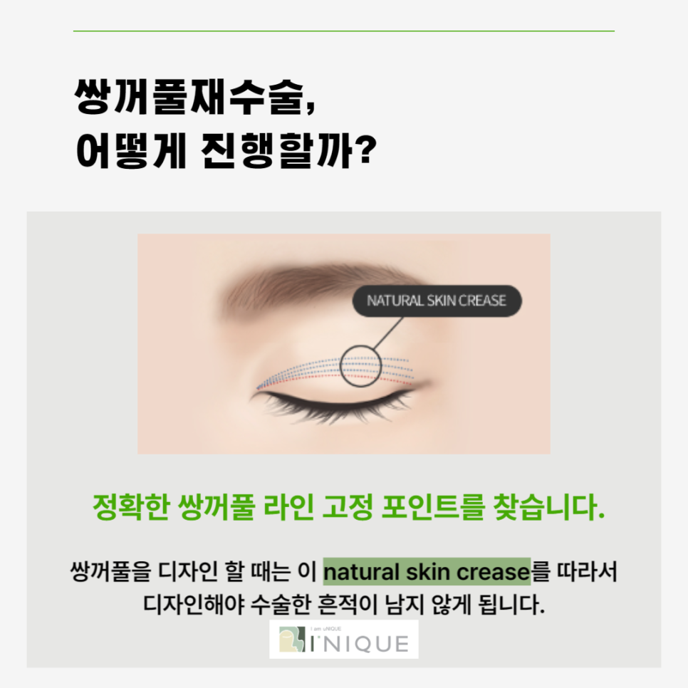 쌍수재수술병원 마지막수술이 되도록 관련 이미지 4