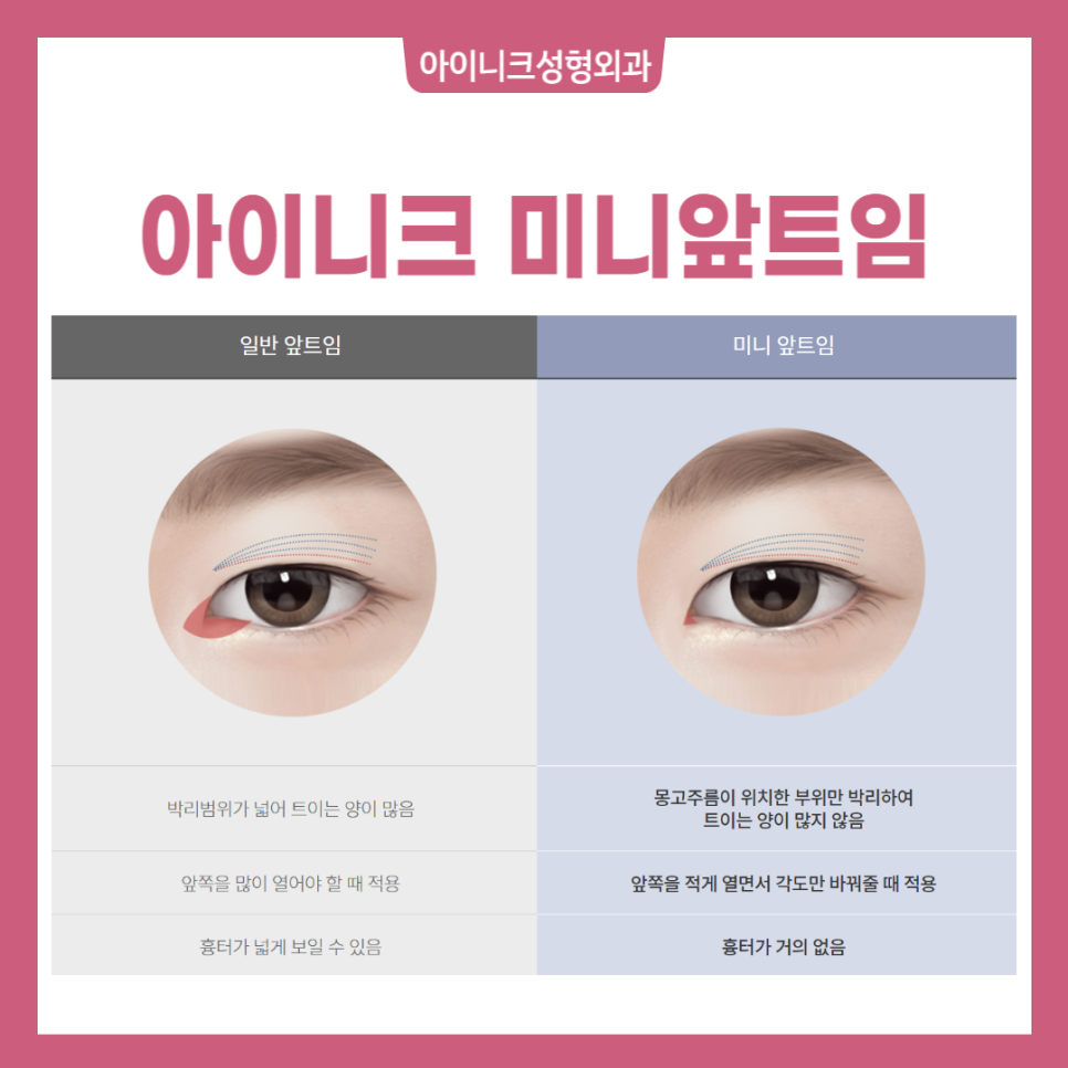 Blepharoplasty for Large, Beautiful Eyes image 3