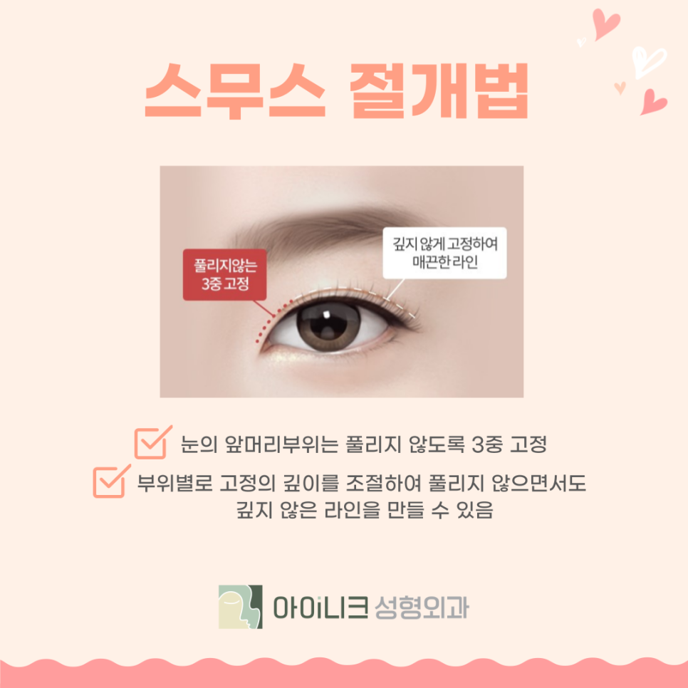 쌍꺼풀잘하는곳 어디로 가야할까? 관련 이미지 7
