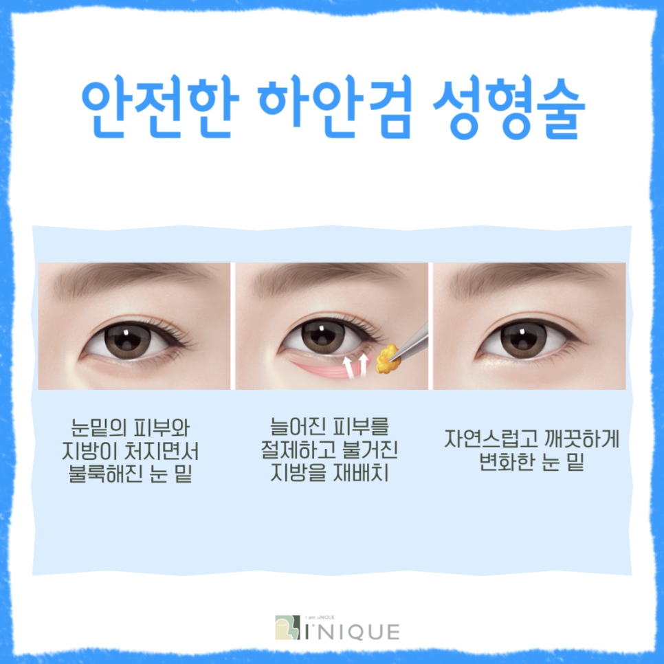 For a Brighter, More Youthful Impression with Midlife Eye Surgery image 5