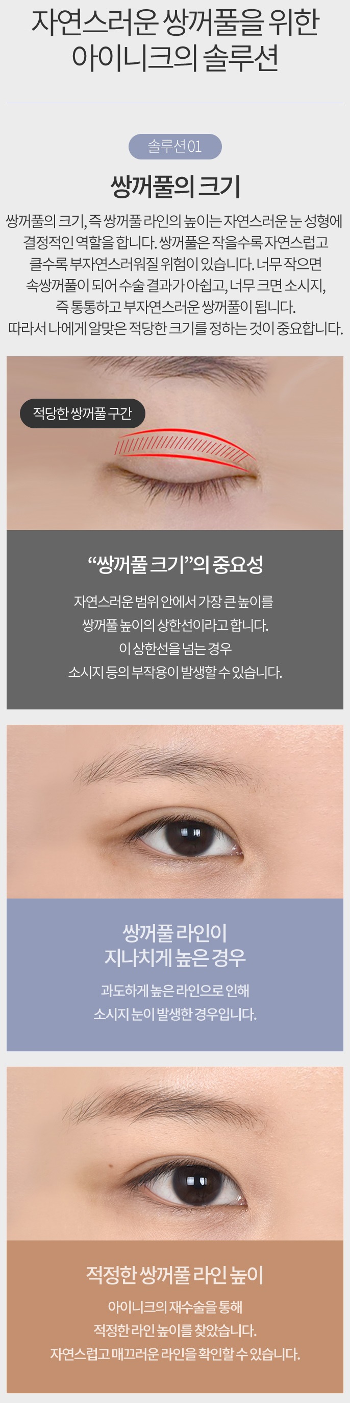 쌍수두께 병원 선택이 중요합니다! 관련 이미지 4