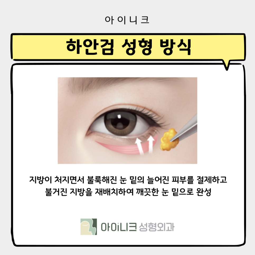 Two Ways to Look 10 Years Younger with Under-Eye Sagging Lifting image 11