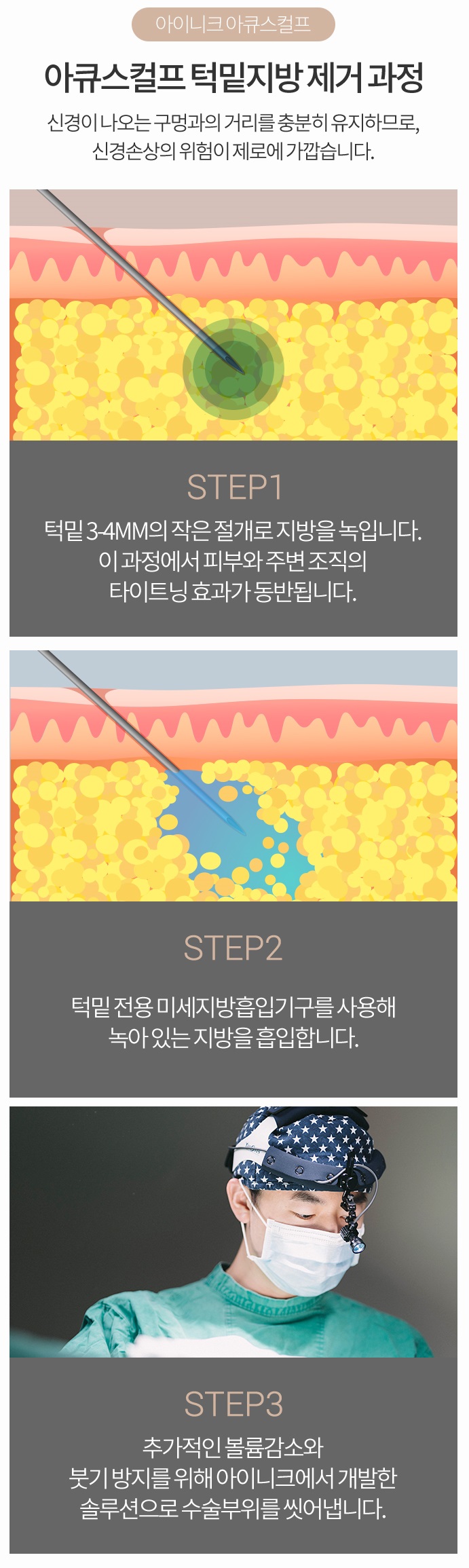 이중턱지방흡입붓기 없이 완벽한 V라인 관련 이미지 4