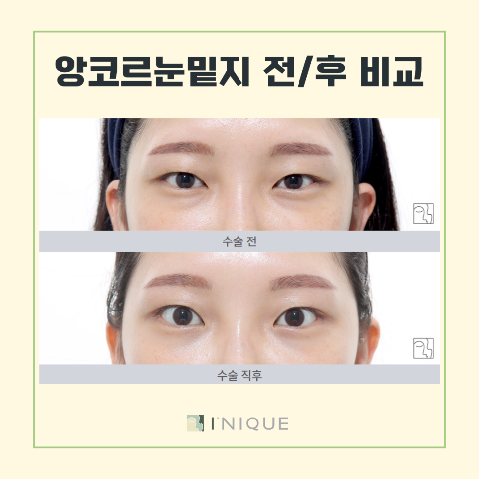 Solving Under-Eye Fat with Encore Laser image 7