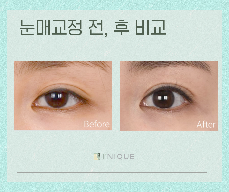 눈매교정잘하는곳 궁금하다면? 관련 이미지 5