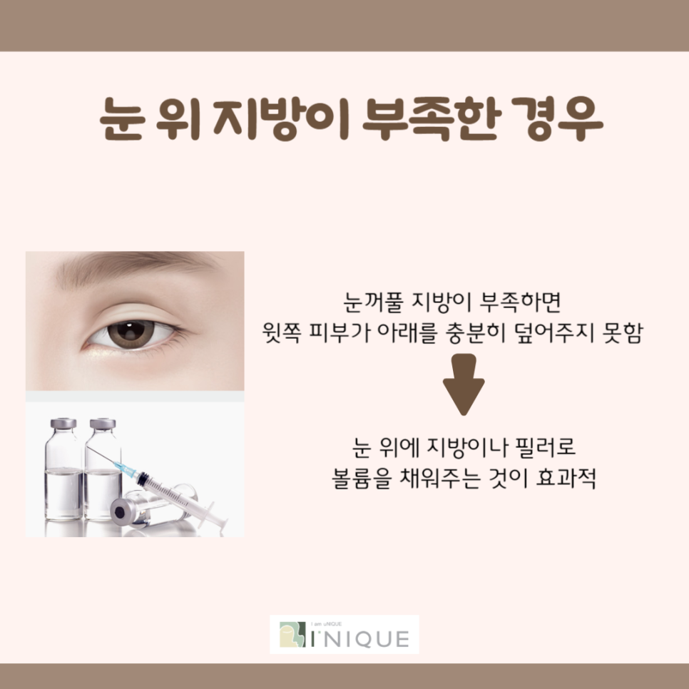 쌍꺼풀재수술잘하는병원은 바로 여기 관련 이미지 4