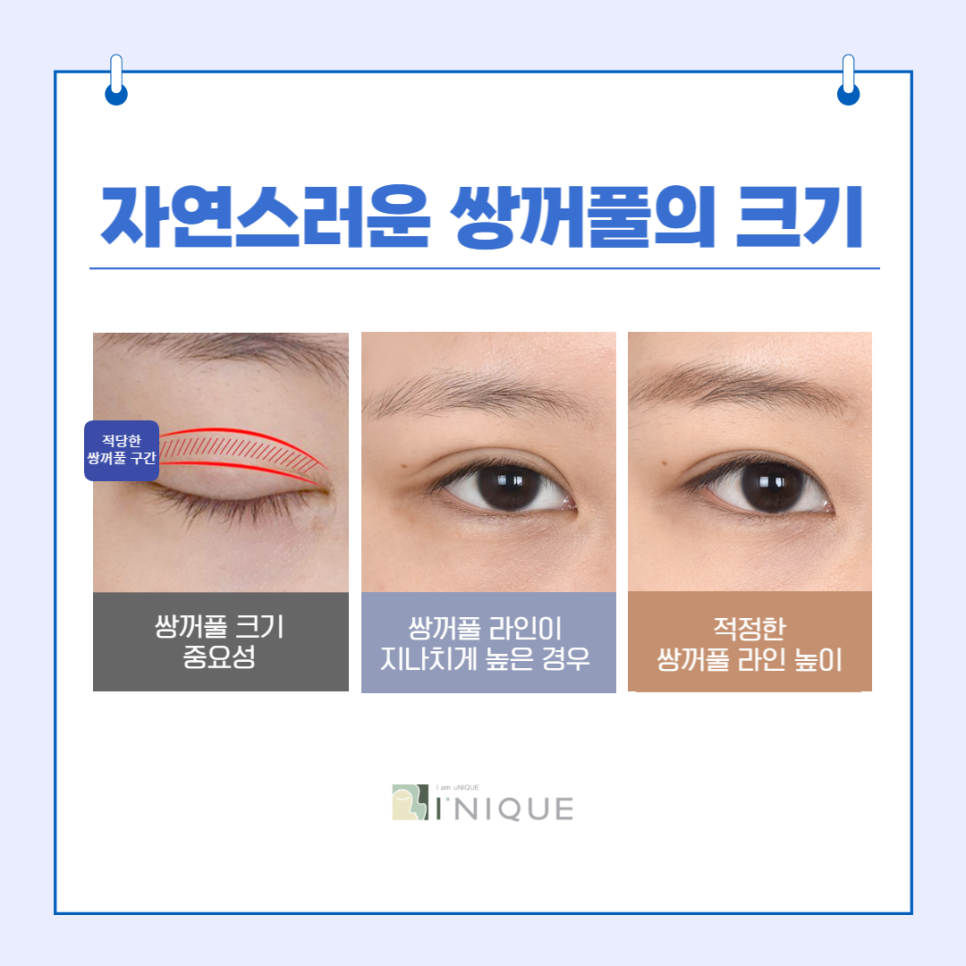 Women’s Double Eyelid Surgery, Naturally with Refined Technique image 2