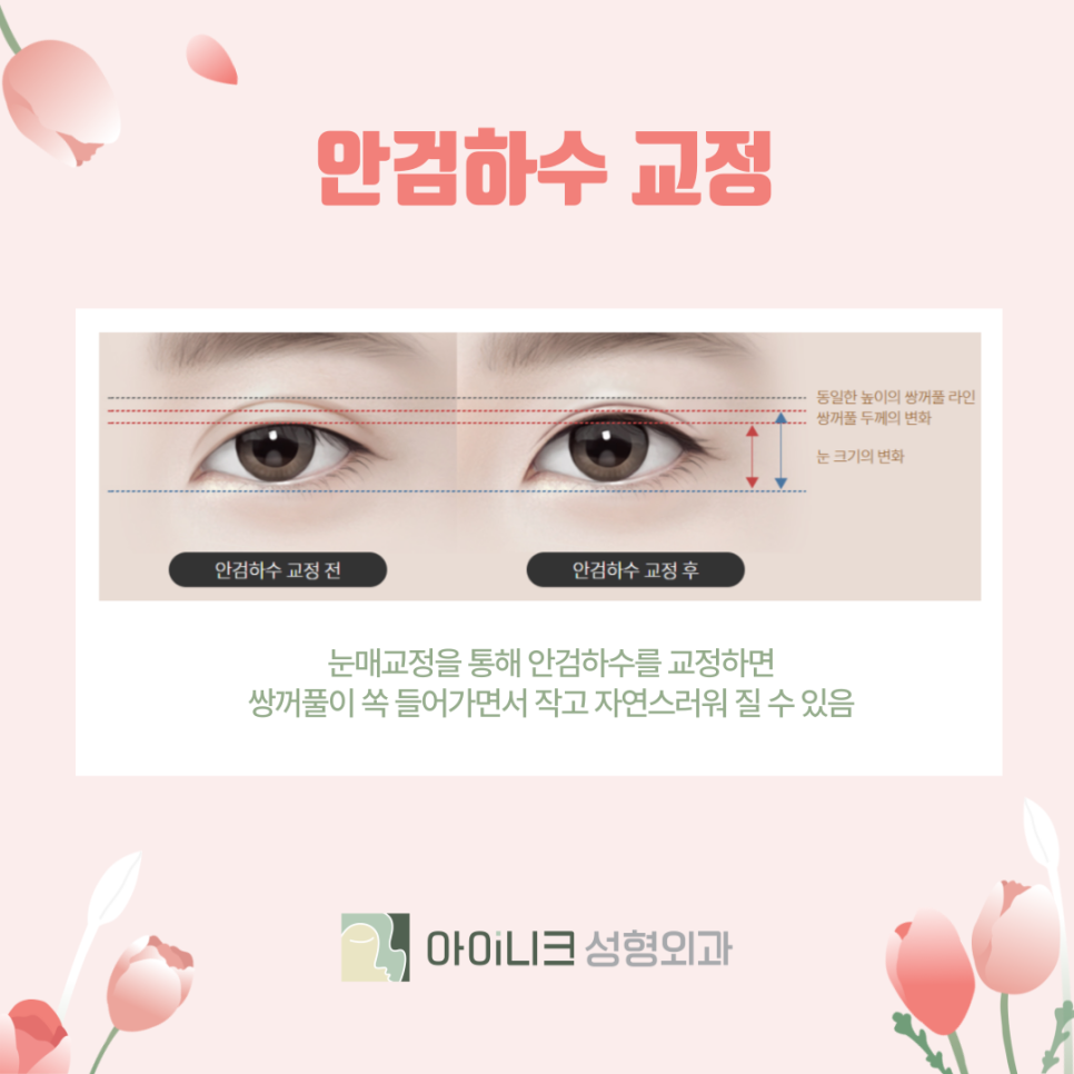 눈성형재수술 성공적으로 하기 위해서는? 관련 이미지 5