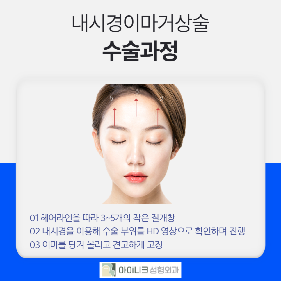 내시경이마거상술 안전하고 확실하게 관련 이미지 4
