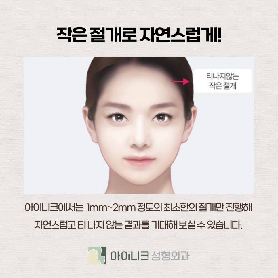 눈썹거상술후기 알아보고 고민될 때 관련 이미지 4