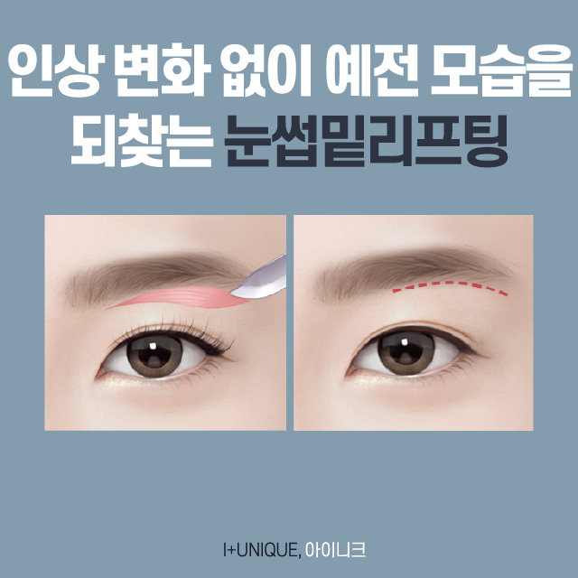 If You're Considering a New Year’s Gift of Filial Piety, Check Out the Types of Eye Surgery for People in Their 40s image 2
