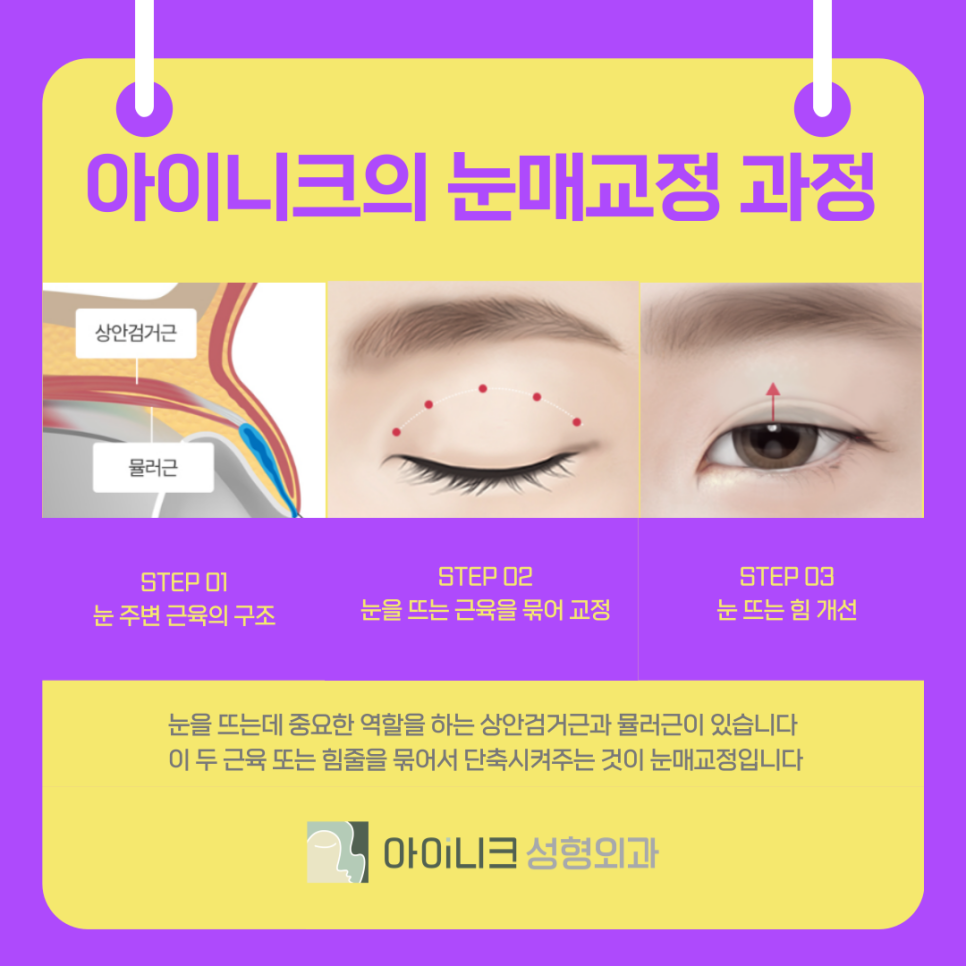 What Is the Non-Incisional Eye Correction Method at a Gangnam Eye Surgery Clinic? image 6