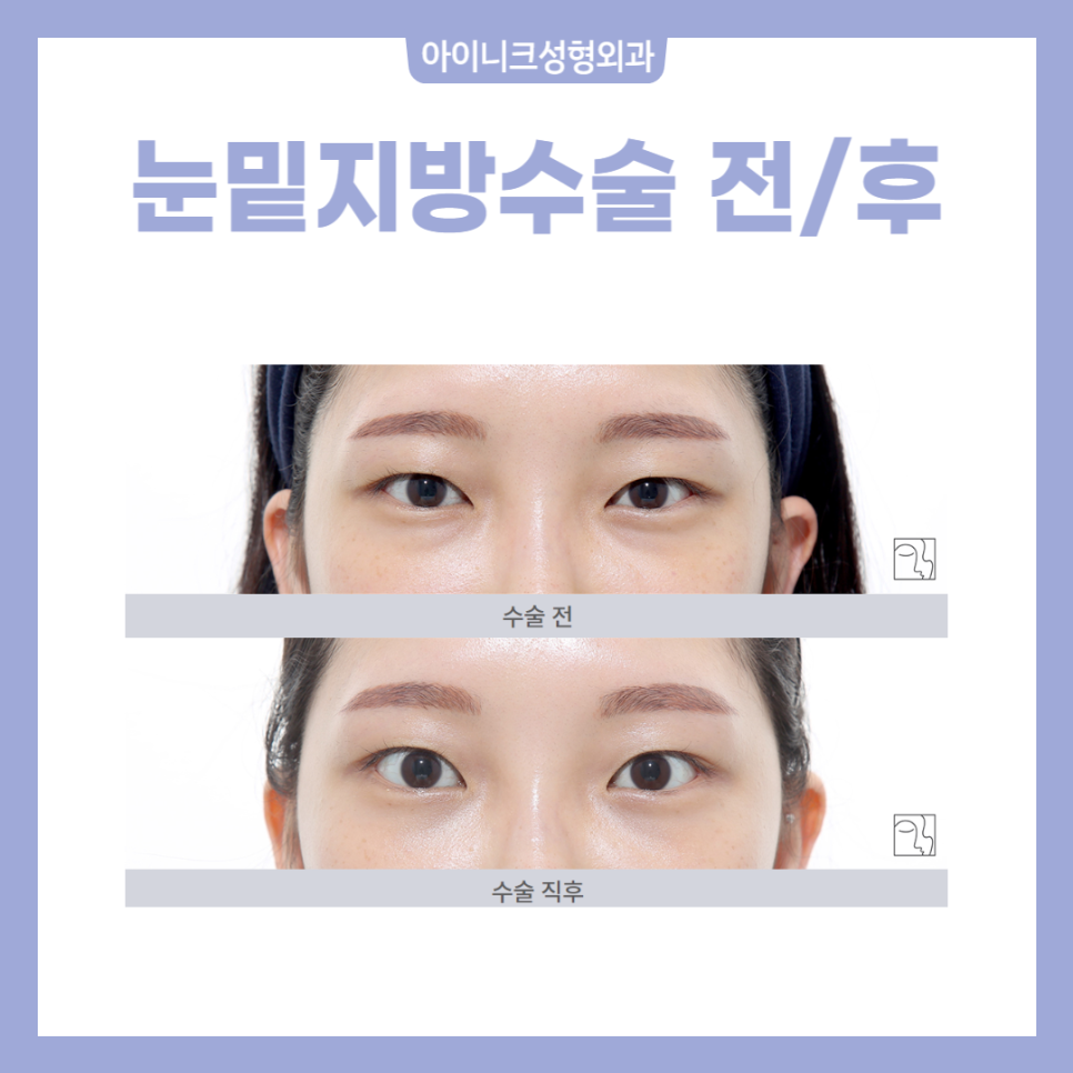 압구정역눈밑수술 걱정 말고 자연스럽게 관련 이미지 2