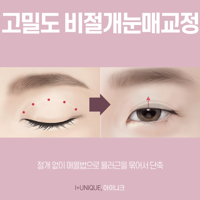 Learn About Incision and Non-Incision Ptosis Correction Without Side Effects image 4