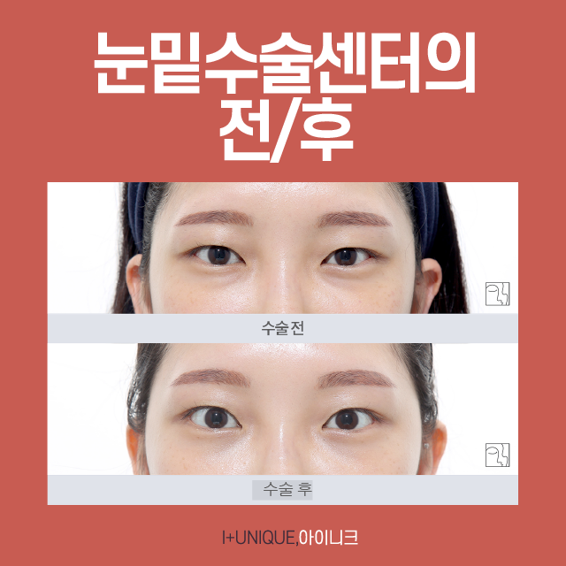 눈밑수술센터 추천, 새로운 개념의 바로 이것 관련 이미지 3