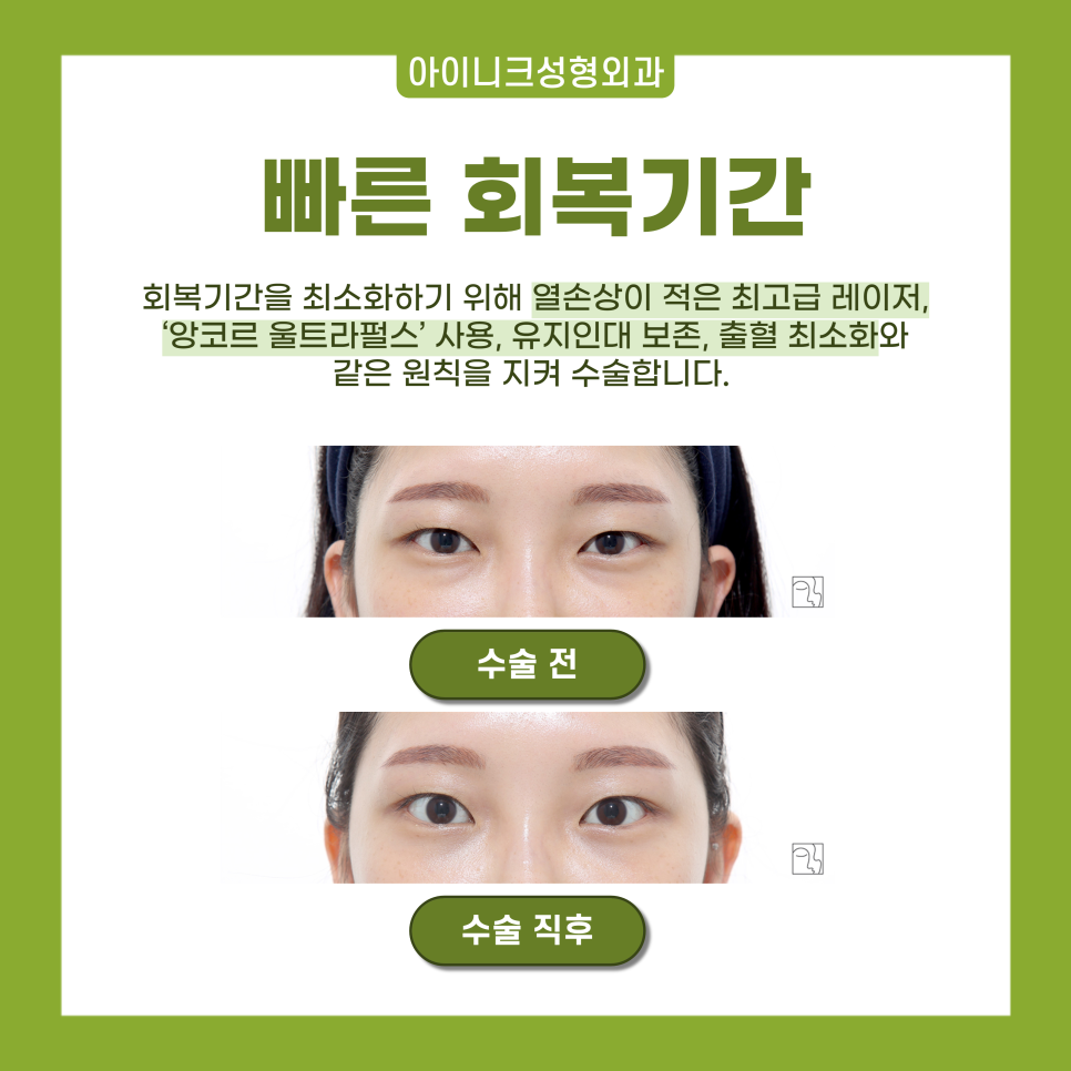 수술 다음 날에도 출근 가능한 다크서클수술 알아보기 관련 이미지 5