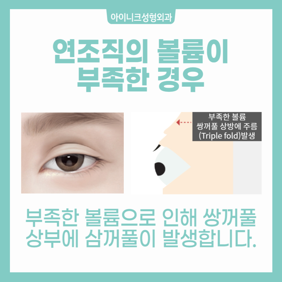 쌍꺼풀 여러겹 해결할 수 있을까? 관련 이미지 5
