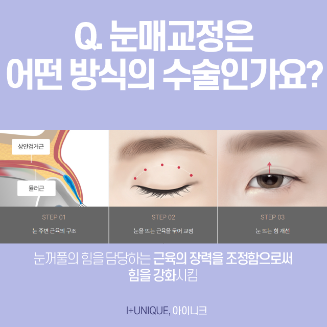 비절개눈매교정 수술로 첫인상 바꾸기 관련 이미지 3