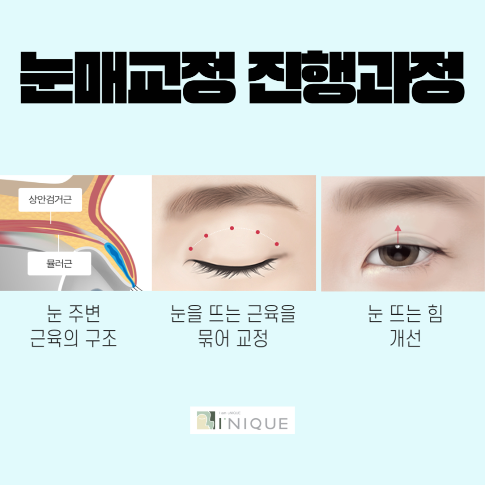 Drooping Eyelid Procedure, with Accurate Diagnosis and Safe Treatment image 4