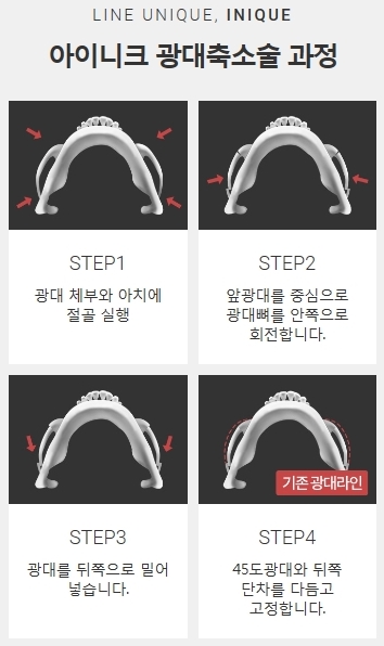 광대축소술가격 합리적인 곳 관련 이미지 3