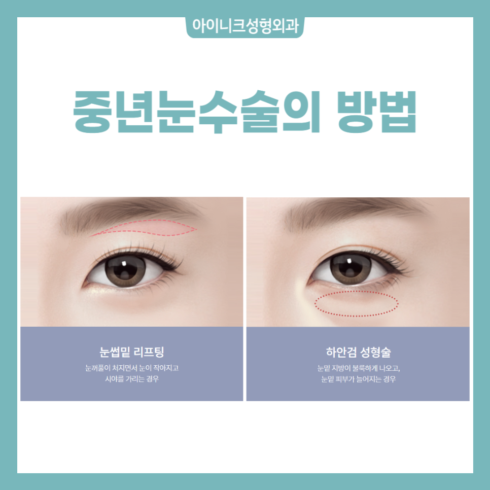 중년눈수술, 젊은 눈으로 되돌리고 싶다면? 관련 이미지 2