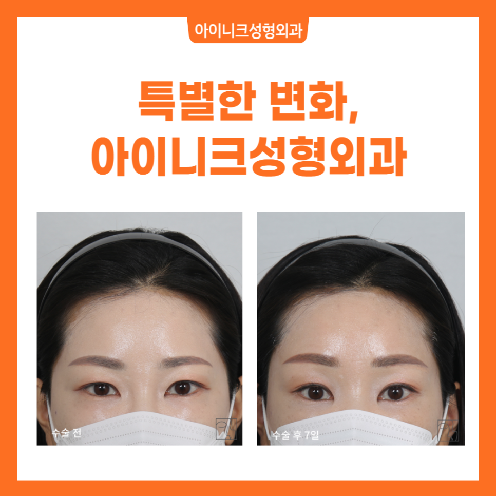 Beautiful Facial Balance with Brow Lift Surgery Recommendations! image 6
