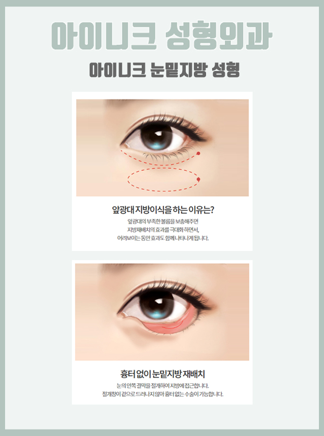 다크서클지방이식 볼륨감을 더해 생기 있는 얼굴로! 관련 이미지 4