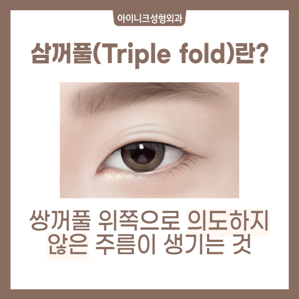 여러겹쌍꺼풀 해결방법을 정확히 알고 싶다면? 관련 이미지 2