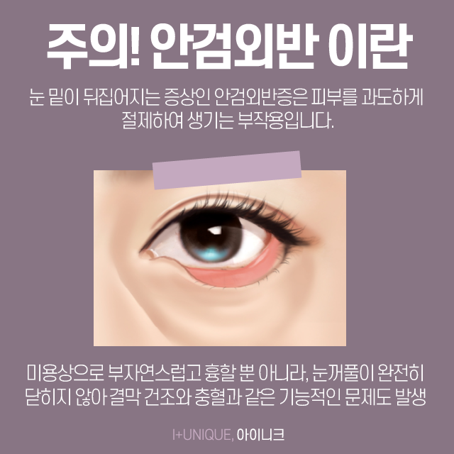 건강하고 환한 얼굴을 위한 하안검잘하는곳 알아보기 관련 이미지 3
