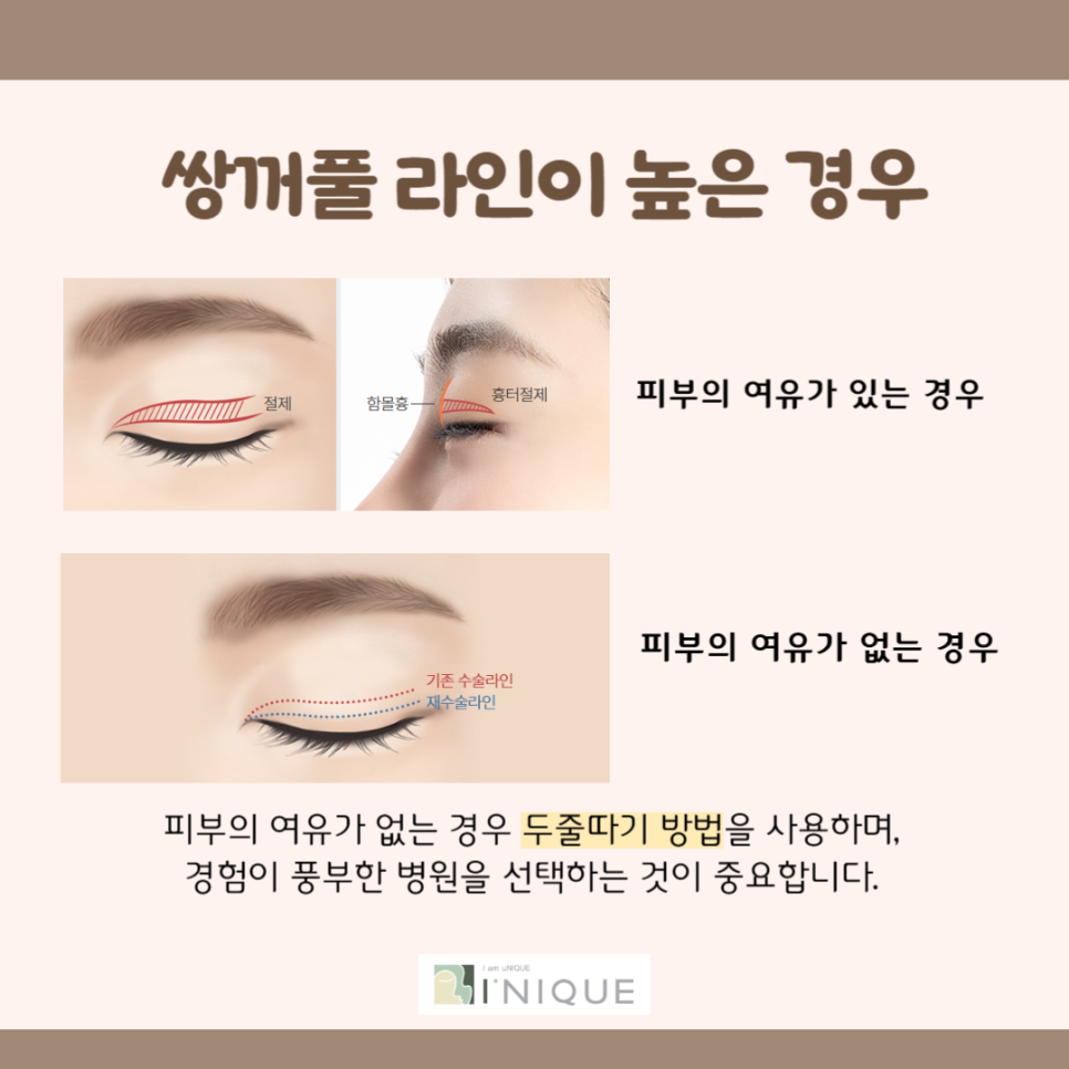 쌍꺼풀재수술잘하는병원은 바로 여기 관련 이미지 5