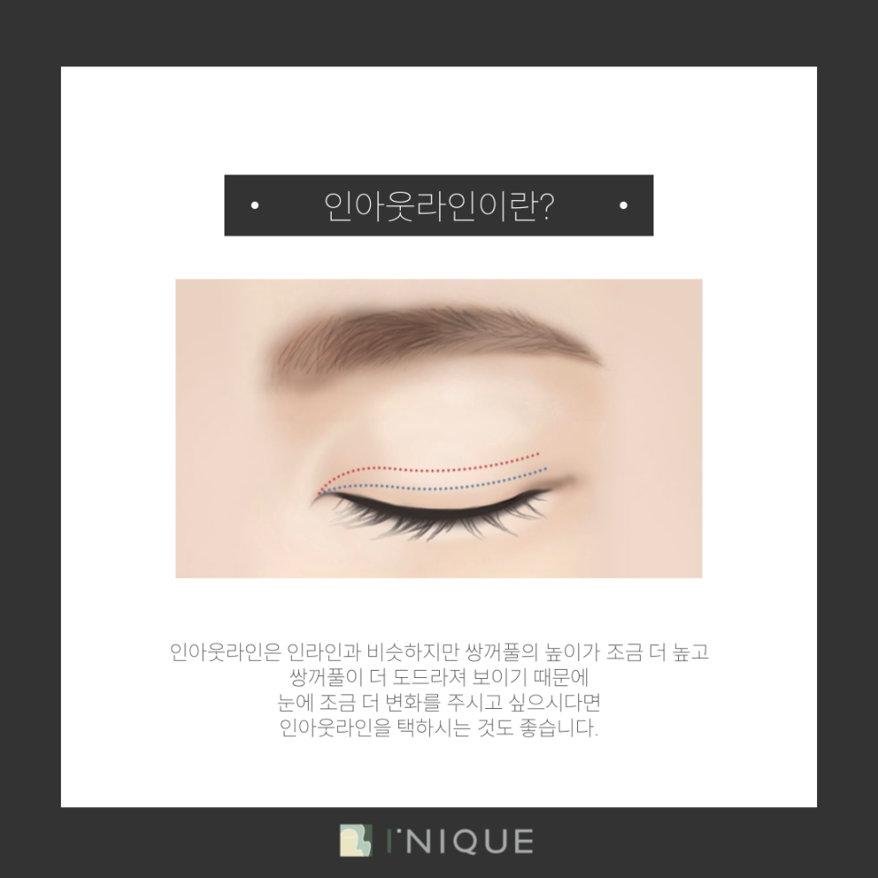 Gangnam Female Eye Surgery: How to Find the Line That Suits You image 4