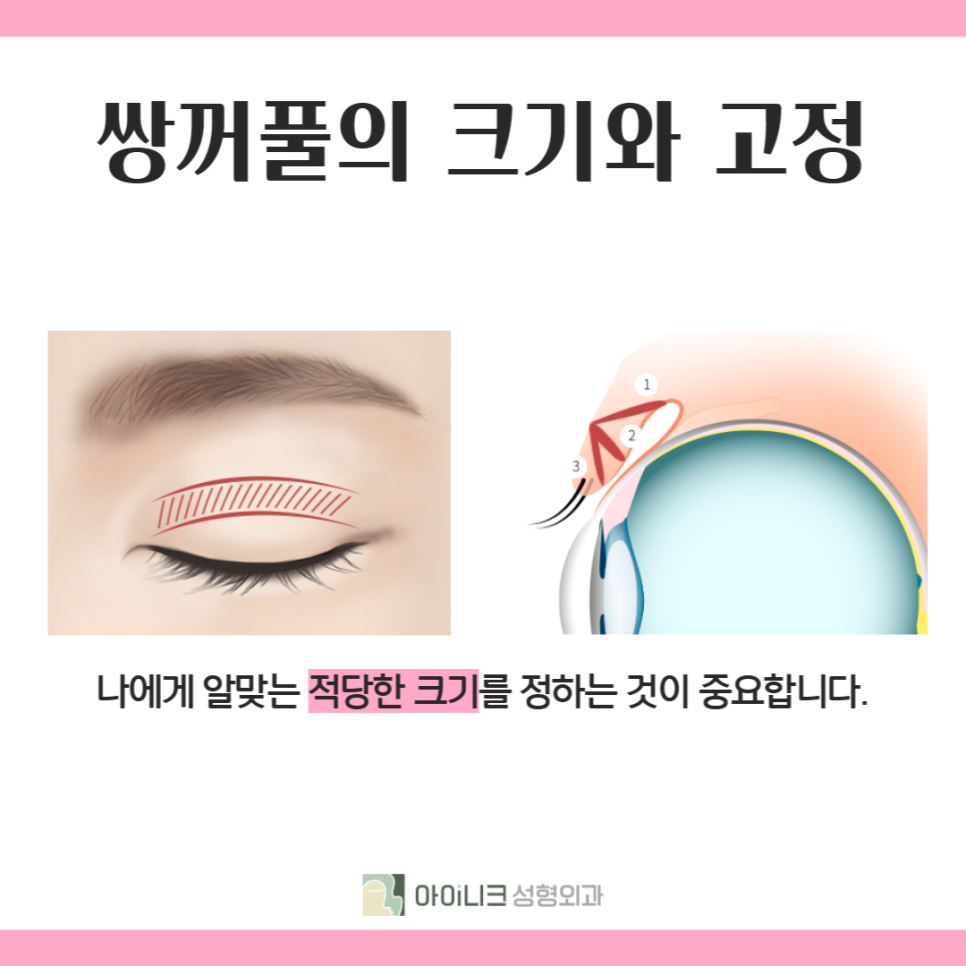 How to Find a Good Double Eyelid Surgery Clinic: Check This! image 4