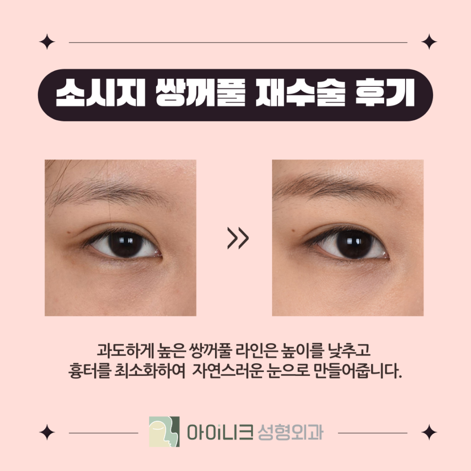 압구정역눈재수술후기 꼭 확인하고 선택하세요 관련 이미지 5