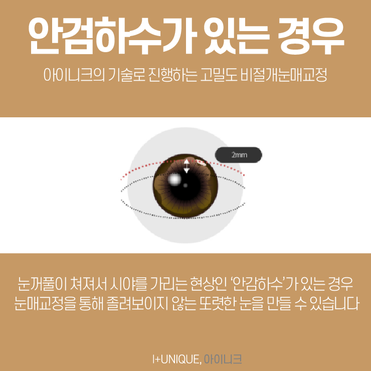 나에게 가장 잘 맞는 눈성형종류 어떤게 있을까 관련 이미지 4
