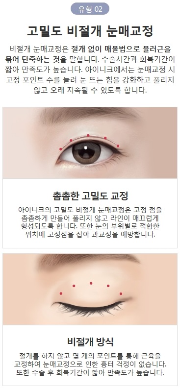 비절개눈매교정술 간단하지만 확실한 관련 이미지 5
