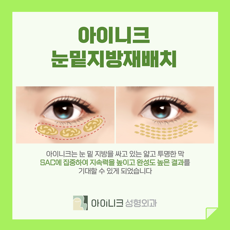 압구정 눈 밑 리프팅 눈밑지방재배치로 처진 주름 올려주기 관련 이미지 5