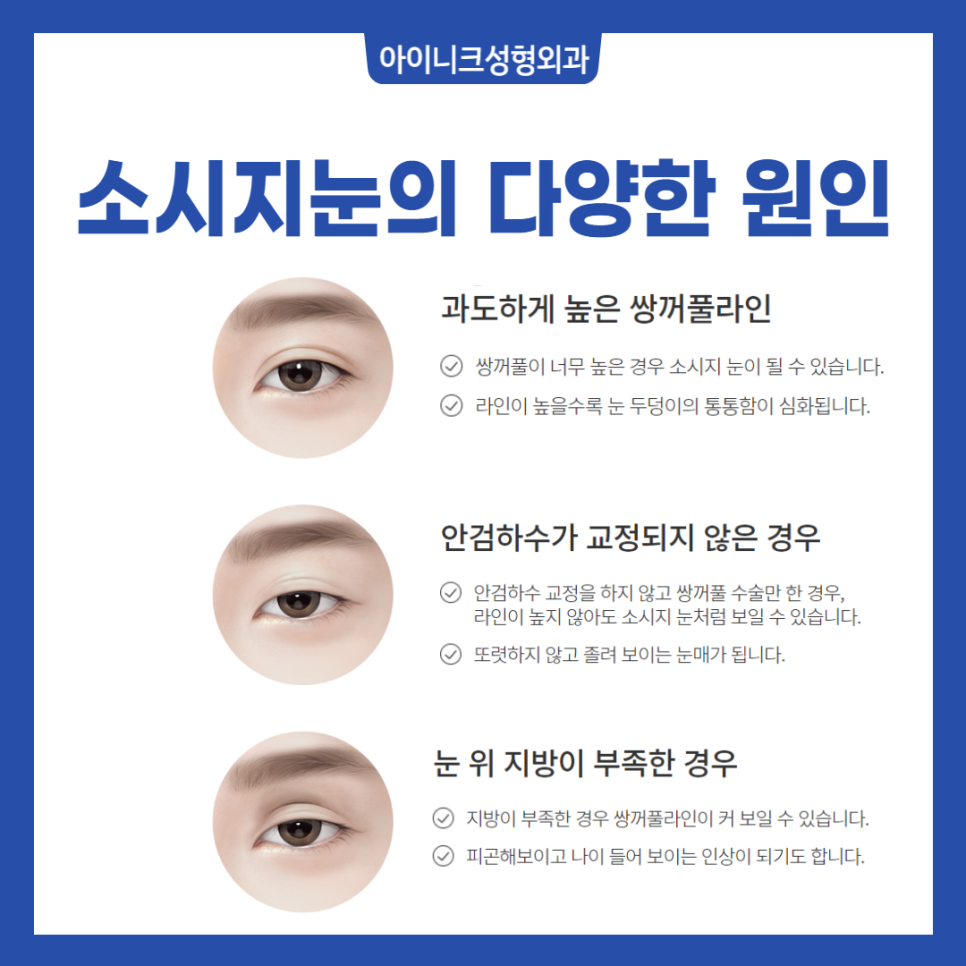 소시지눈재수술 원인부터 파악해야 실패 없어요 관련 이미지 2